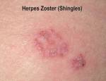 Shingles